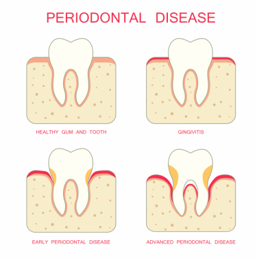 Periodontics Dentistry