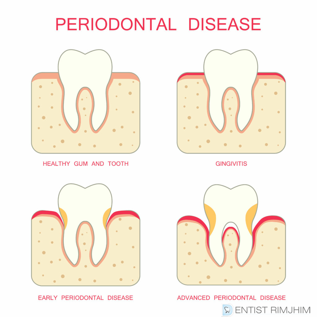 Periodontics Dentist in Delhi