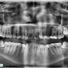 Teeth Radiology Reports