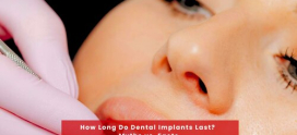 How Long Do Dental Implants Last? Myths vs. Facts