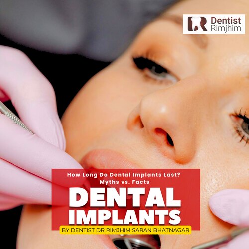 How Long Do Dental Implants Last? Myths vs. Facts