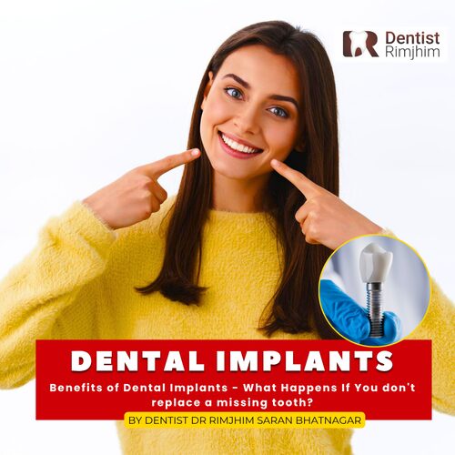 Benefits of Dental Implants – What Happens If You Don’t Replace a Missing Tooth?