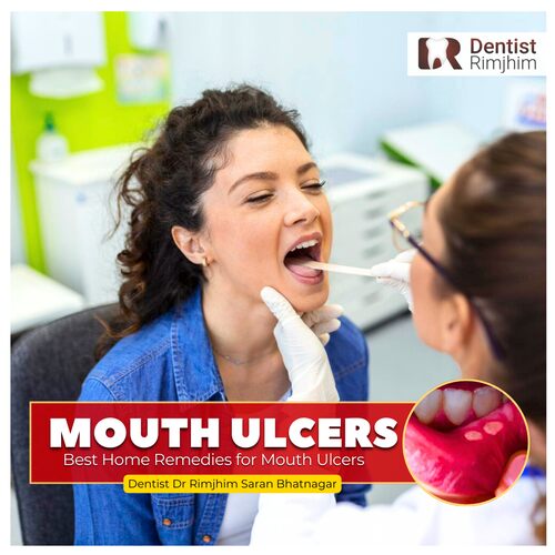 Best Home Remedies for Mouth Ulcers – By Dentist Dr Rimjhim