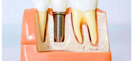Why Dental Implants Are Becoming the Gold Standard for Missing Teeth
