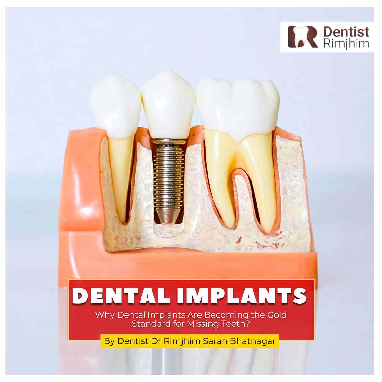 Why Dental Implants Are Becoming the Gold Standard for Missing Teeth