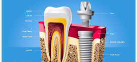 Why Dental Implants Are Becoming the Gold Standard for Missing Teeth