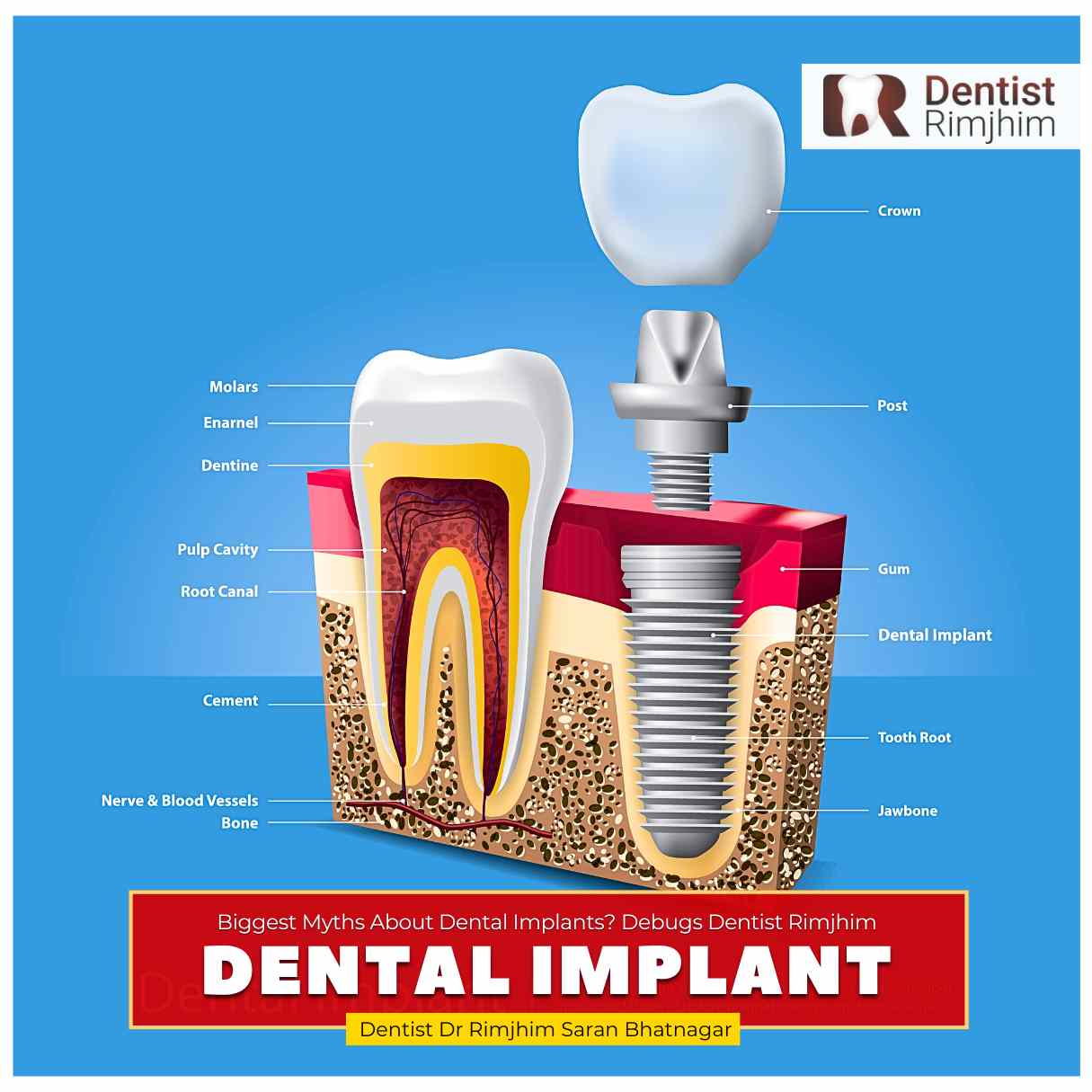 What Are the Biggest Myths About Dental Implants? Reveals Dentist Rimjhim