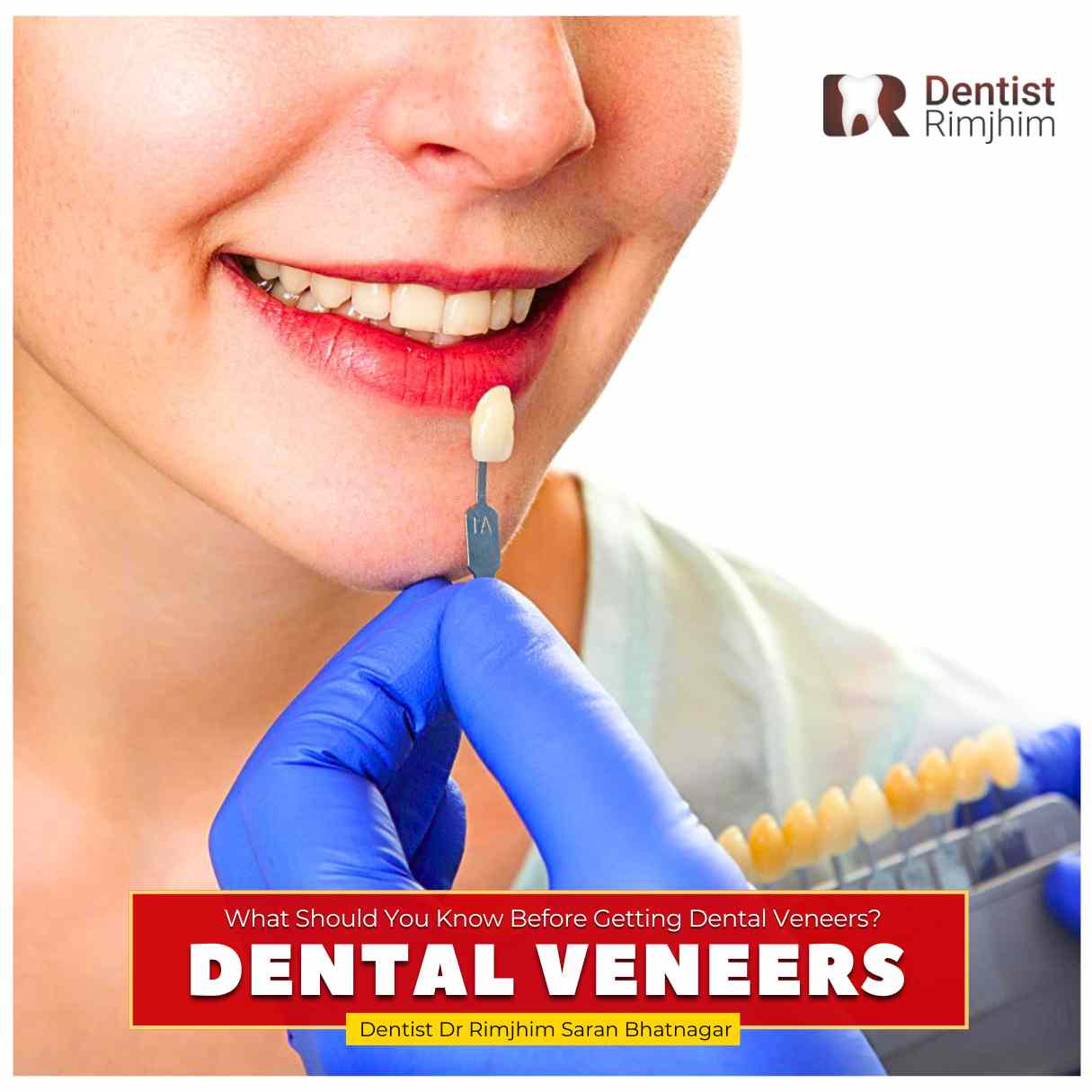 What Should You Know Before Getting Dental Veneers?