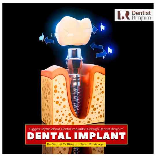 best dentist for implants in delhi_dr rimjhim saran bhatnagar