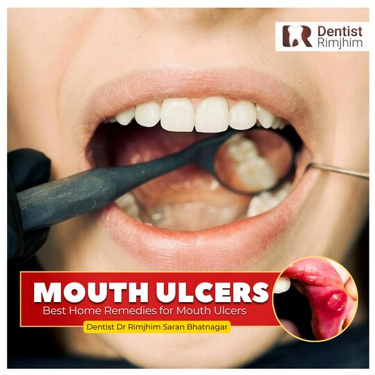 Best Home Remedies for Mouth Ulcers