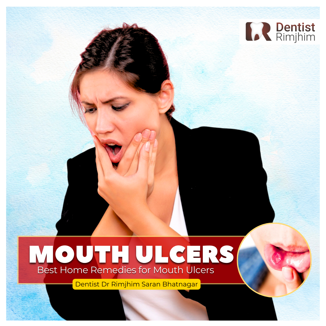Best Home Remedies for Mouth Ulcers – By Dentist Dr Rimjhim