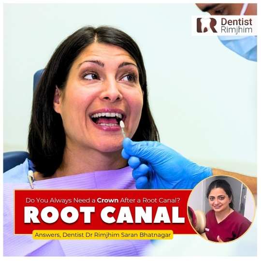 Do You Always Need a Crown After a Root Canal?