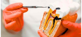 Single Sitting Root Canal Treatment: Is It Right for Everyone? Answers Dental Expert