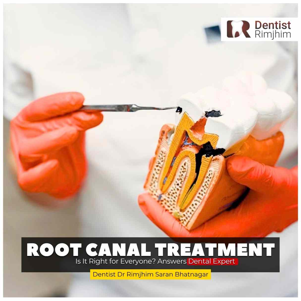 Single Sitting Root Canal Treatment: Is It Right for Everyone? Answers Dental Expert